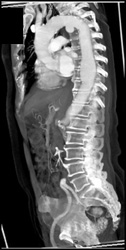 Ductus Aneurysm - CTisus CT Scan