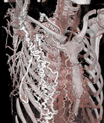 SVC Occlusion With Collaterals - CTisus CT Scan