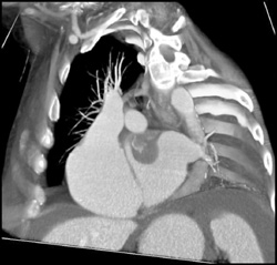 Atrial Myxoma - CTisus CT Scan