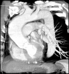 Dilated Aortic Arch - CTisus CT Scan