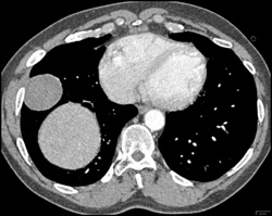 Pulmonary Hematoma - CTisus CT Scan