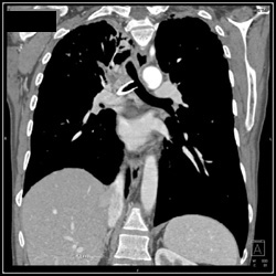 Stent in Right Mainstem Bronchus With Lung Cancer - CTisus CT Scan