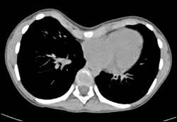 Pectus Deformity - CTisus CT Scan