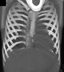 Pectus Deformity - CTisus CT Scan