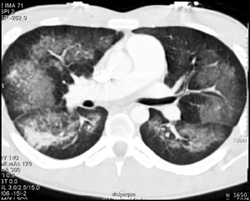 Pulmonary Hemorrhage - CTisus CT Scan