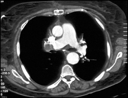 Pulmonary Embolism - CTisus CT Scan