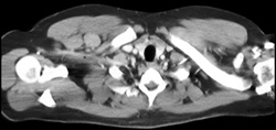 Axial Nodes (right) - CTisus CT Scan