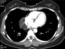 Pericardial Cyst - CTisus CT Scan