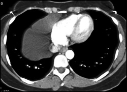 Pericardial Cyst - CTisus CT Scan