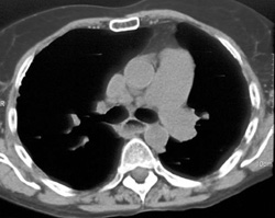 Dilated Esophagus - CTisus CT Scan