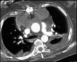 Post Operative Mediastinal Abscess - CTisus CT Scan