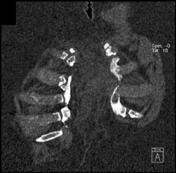 Dehisence of the Sternal Fusion - CTisus CT Scan