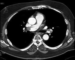 Saddle PE - CTisus CT Scan