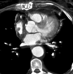 Multiple Pulmonary Emboli (PEs) - CTisus CT Scan