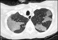 Mosiac Infiltrate - CTisus CT Scan