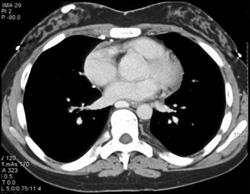 Collateral in Chest Wall - CTisus CT Scan