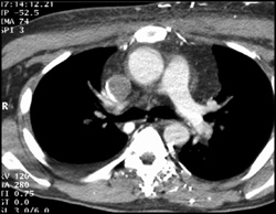 SVC  Clot - CTisus CT Scan