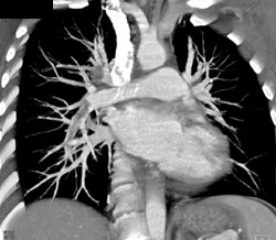 Pe - CTisus CT Scan