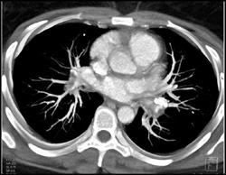 Pulmonary Embolism (PE) in 3D - CTisus CT Scan