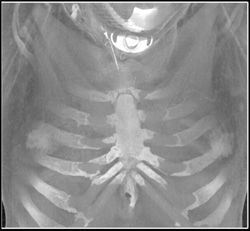 Tracheostomy - CTisus CT Scan