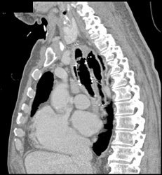 Te Fistulae - CTisus CT Scan