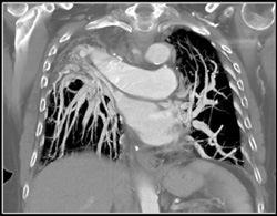 Fibrosis With Elevated Pulmonary Vessels - CTisus CT Scan