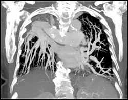 Dilated Pulmonary Artery - CTisus CT Scan