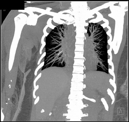 Broken Catheter in Right Pulmonary Artery - CTisus CT Scan