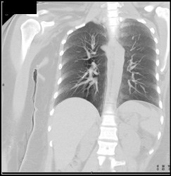 Catheter in Right Pulmonary Artery - CTisus CT Scan