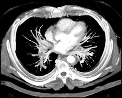 Pe - CTisus CT Scan