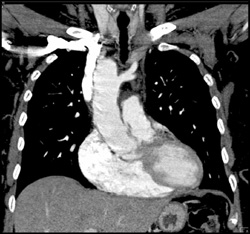 Aberrant Subclavian Artery - CTisus CT Scan