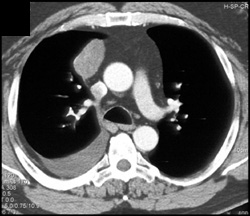 Thymoma - CTisus CT Scan