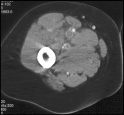 Deep Vein Thrombosis (DVT) - CTisus CT Scan