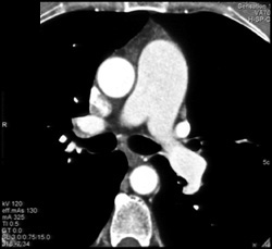 Chronic Pulmonary Emboli (PEs) - CTisus CT Scan