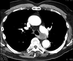 Ductus Aneurysm - CTisus CT Scan