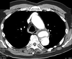 Ductus Aneurysm - CTisus CT Scan