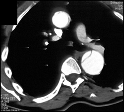 Aortic Dissection - CTisus CT Scan