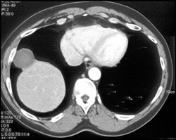 Hematoma Simulates A Nodule - CTisus CT Scan