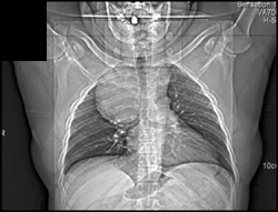 Substernal Thyroid - CTisus CT Scan