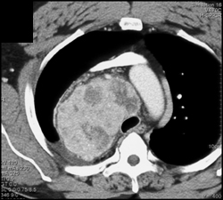 Substernal Thyroid - CTisus CT Scan