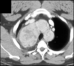 Substernal Thyroid - CTisus CT Scan