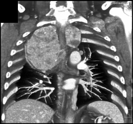 Substernal Thyroid - CTisus CT Scan