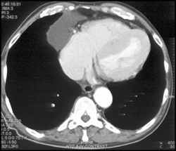 Pericardial Cyst - CTisus CT Scan