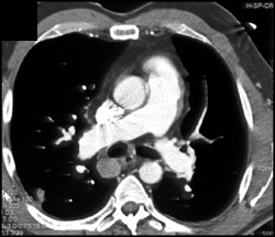 Pe - CTisus CT Scan