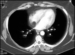 Lipoma in Right Atrium - CTisus CT Scan