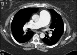 Enlarged Main Pulmonary Trunk - CTisus CT Scan