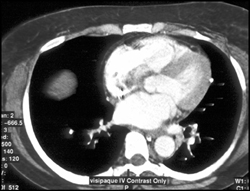 Vessel Along Left Heart Border Is Phrenic Artery - CTisus CT Scan