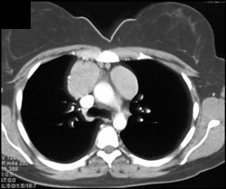 Lymphoma - CTisus CT Scan