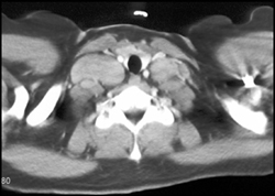 Lymphoma With Nodes - CTisus CT Scan