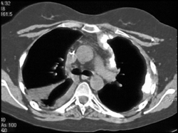 Calcified Pleural Implants - CTisus CT Scan